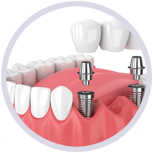 임플란트 식립으로 잇몸뼈의 흡수까지 방지